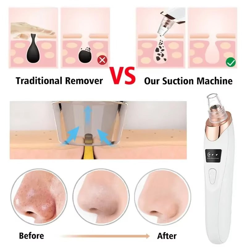 BLACK HEAD REMOVAL