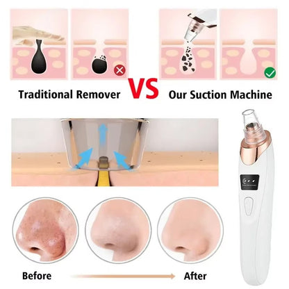 BLACK HEAD REMOVAL